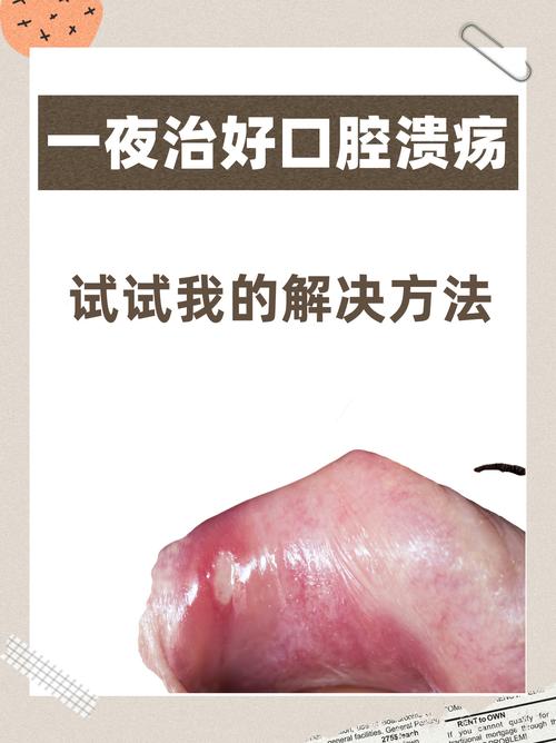 口腔溃疡根治实验（口腔溃疡特效验方）