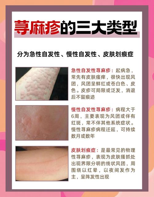 季节性过敏源排查术（季节性过敏要查过敏原吗）