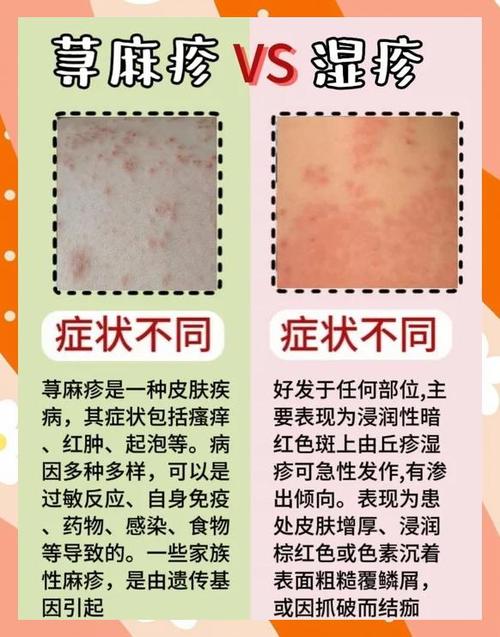 春季麻疹风疹预防常识(春季荨麻疹怎么预防)