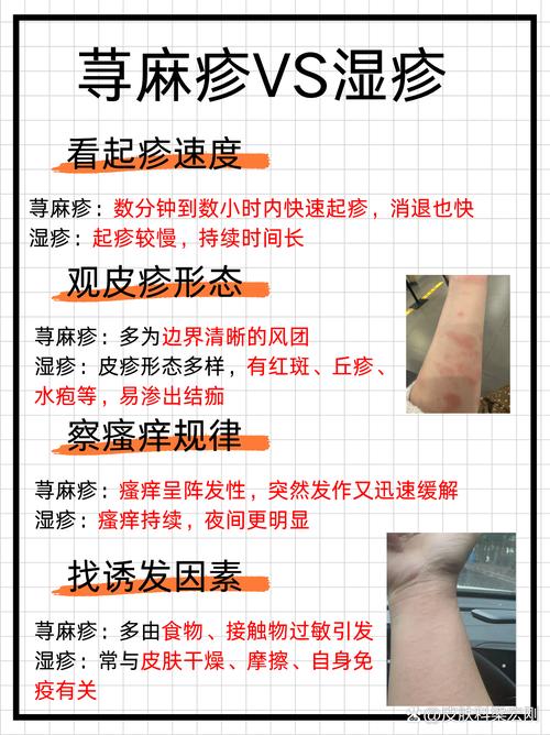常见病毒性皮肤病预防(病毒性皮疹怎么预防)